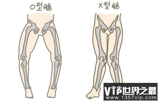 O型腿的原因是什么？如何矫正O型腿