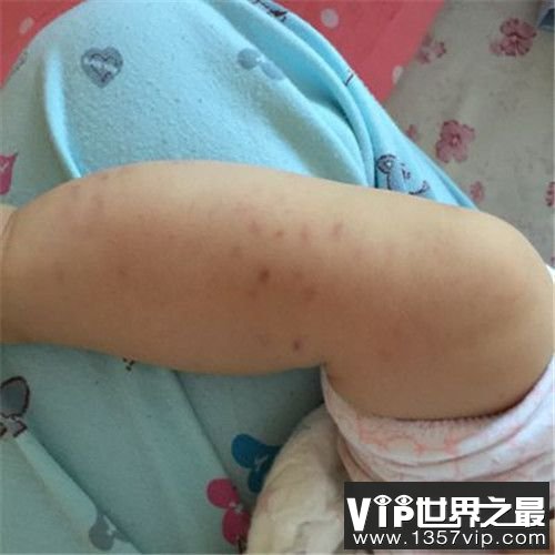 【小孩子得了儿童过敏性紫癜怎么办】主要表现的症状 需要注意什么事项