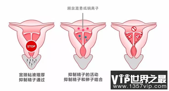 激素类节育环