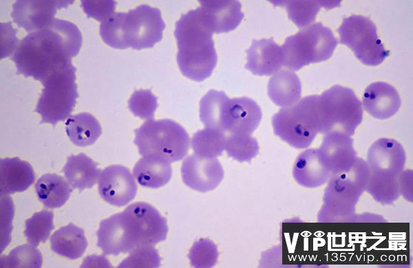 疟原虫治癌症？实际只是科学猜想