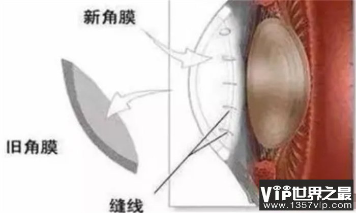 猪皮可以做眼膜吗（可以）